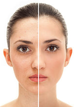 Load image into Gallery viewer, Fotorejuvenecimiento con IPL